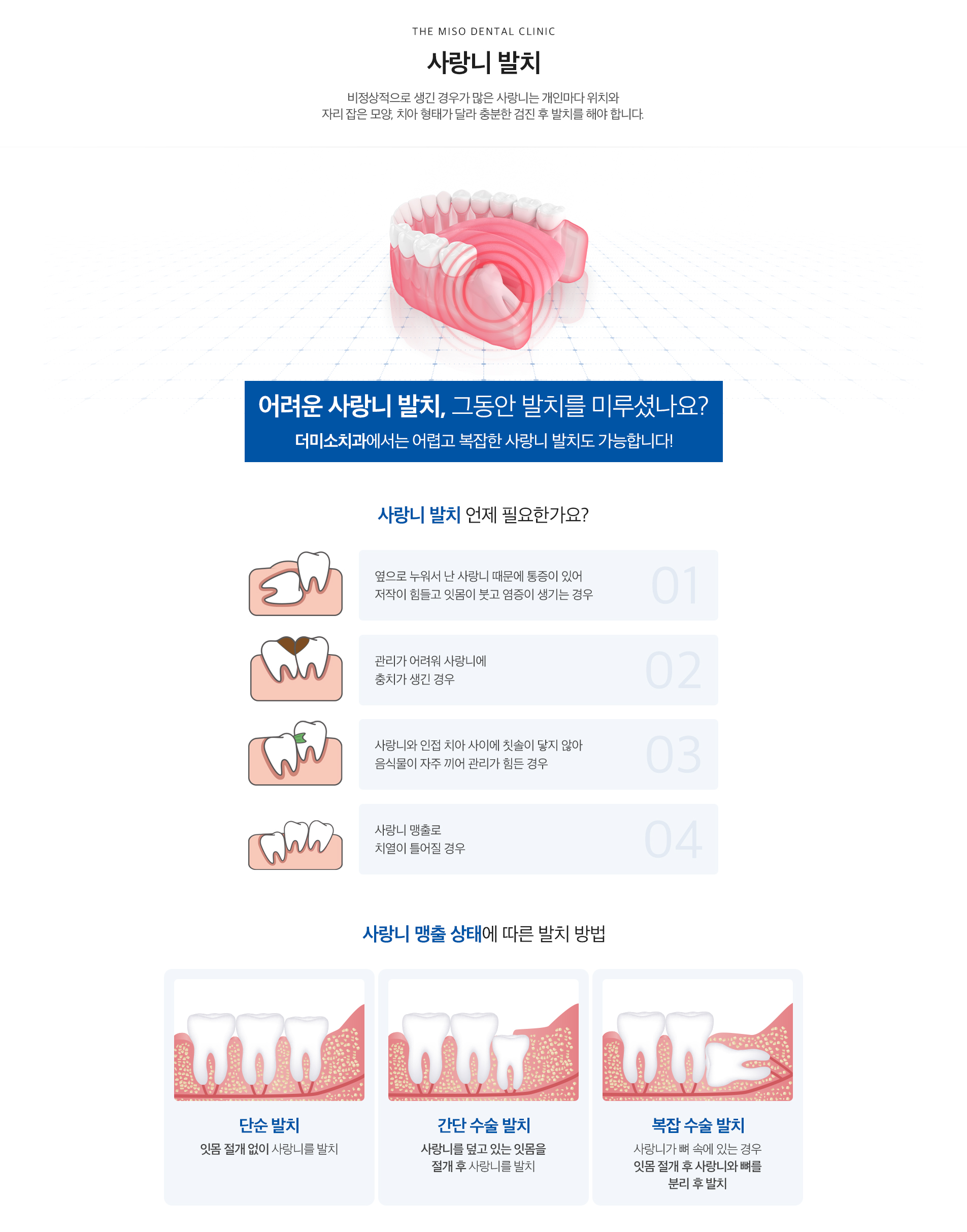 사랑니 발치