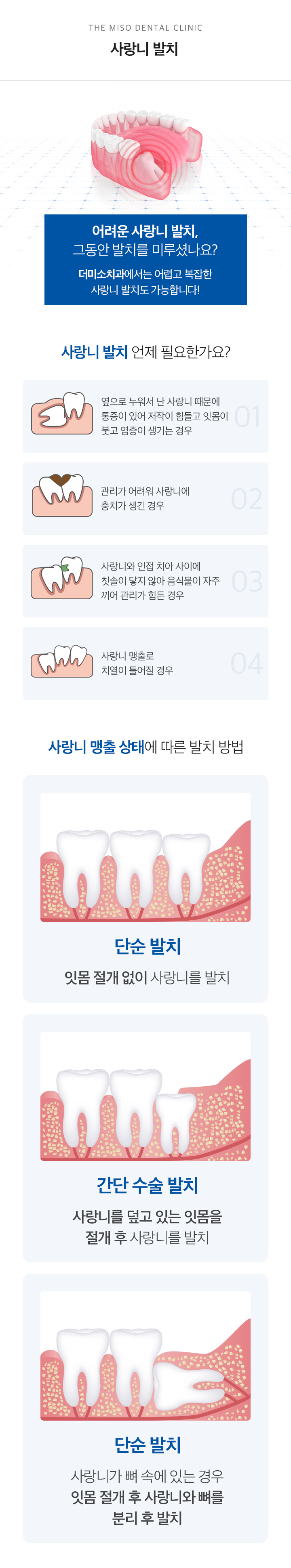 사랑니 발치